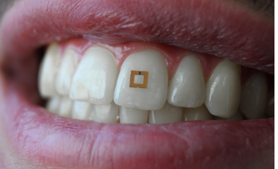 科學(xué)家開(kāi)發(fā)出新型牙齒傳感器 可測(cè)量糖、鹽等的攝入量