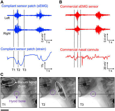 柔性可穿戴貼片傳感器可幫助數(shù)百萬吞咽障礙患者 柔性可穿戴貼片傳感器可幫助數(shù)百萬吞咽障礙患者